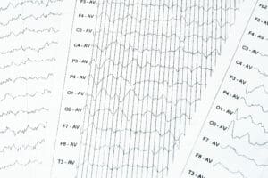EEG electrophysiological monitoring method. EEG wave in human brain, Brain wave patterns on electroencephalogram, EEG of the child, detect problems in the electrical activity of the brain