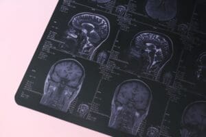 MRI showing brain shrinkage due to stress